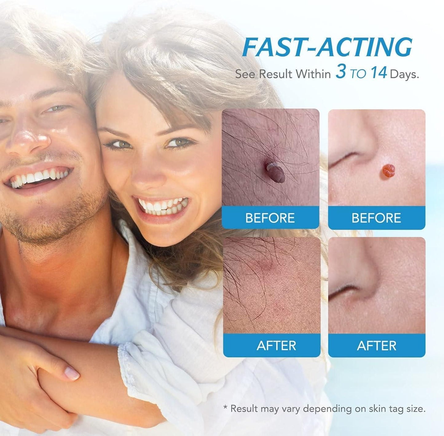 2 in 1 Skin Tag Remover Kit - Painless